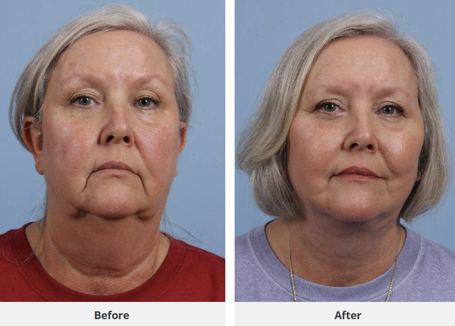 Patient result