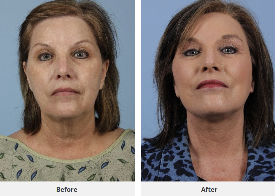 Patient result