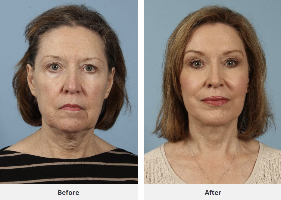 Patient result